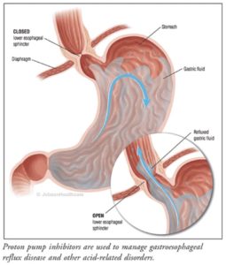 All Hands On Deck to Reduce Acid Reflux, Just for Today